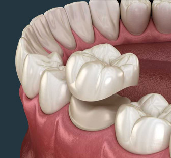 cabinet-dentaire-pricop-traitement-caries-le-mans representation-traitement-de-caries-3D-le-mans